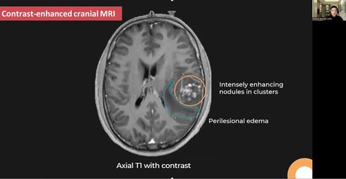 Contrast-enhanced cranial MRI findings in a 39-year-old Filipino male with cerebral schistosomiasis: a case report